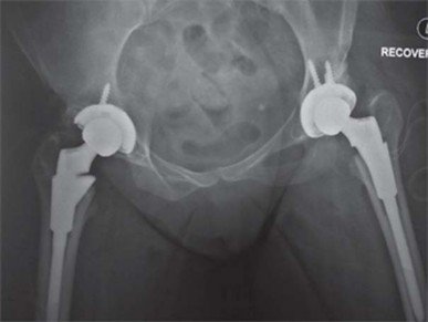 Illustration 42 for Successful Total Hip Replacement in Developmental Dysplasia