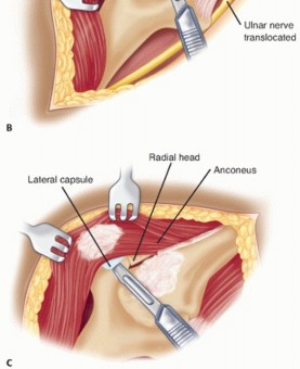 Illustration 32 for Surgical Approaches to Shoulder & Elbow: Pearls and Pitfalls