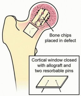 Illustration 7 for Head-Sparing for Osteonecrosis of the Femoral: Preserve Your Hip