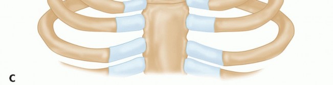 Illustration 13 for Optimizing SC Dislocation Repair After Medial Clavicle Resection