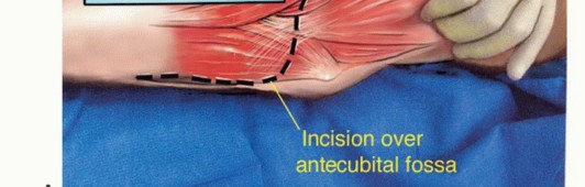 Illustration 7 for Distal Humeral Resection: Safe Techniques for Limb Preservation