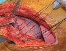 Illustration 50 for Mastering Anterior Interbody Arthrodesis with Instrumentation for Scoliosis