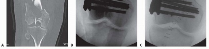 Illustration 60 for Repairing Distal Femur Fractures: Open Reduction & Internal Fixation