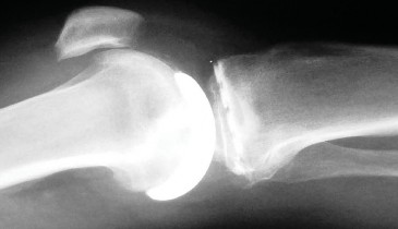 صورة توضيحية لـ تقويم مفصل الركبة أحادي الحجرة دليل شامل للمرضى في صنعاء