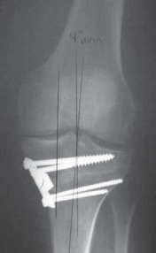 Illustration 51 for Guide Pin Assembly: Key to Flawless Upper Tibial Osteotomy