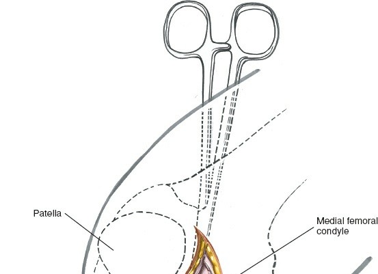 Illustration 232 for Mastering Knee Approaches: Spotlight on Superficial Medial Ligament