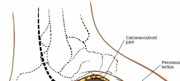 Illustration 190 for Optimized Approaches to the Dorsum of the Foot & Ankle