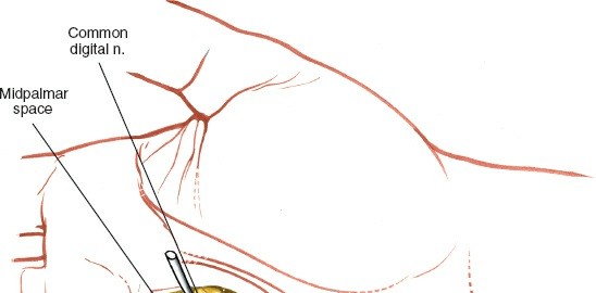 Image demonstrating a hand exercise for rehabilitation