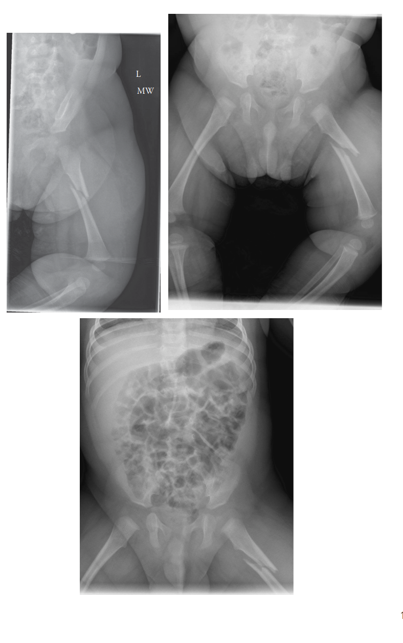 Nonaccidental Injury (NAI) in Pediatric Orthopedics: Identification & Management Guide