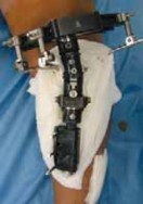 Illustration 17 for Conquering Adolescent Blount's Disease: A Surgical Guide