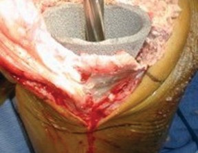 Illustration 10 for Porous Metal Cones: Biologic Fixation for Severe Bone Loss