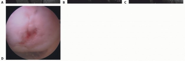 Damaged Cartilage? Explore Fresh Osteochondral Allografts