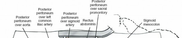 Illustration 18 for Expert Guide: Transperitoneal and Retroperitoneal Lumbar Access