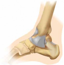 Illustration 2 for Optimal Fixation of the Ankle: Open Reduction & Internal Fixation