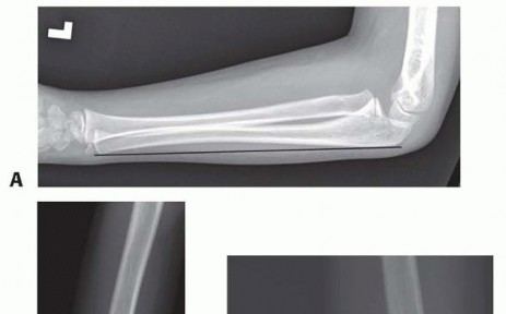 Reconstruction for Missed Monteggia Lesion