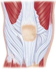 Minimally Invasive Subvastus: The Best Path to Quicker TKA Recovery
