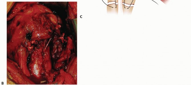 Illustration 15 for Optimizing Fixation of Proximal Humerus Fractures: A Guide