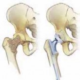 Illustration 15 for Advanced Arthroplasty for Malignant Lesions: Reclaim Your Mobility