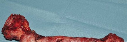 Illustration 77 for Optimizing Infected THA: The One Staged Approach Explained