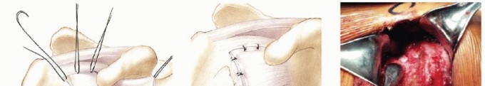 Illustration 31 for Bankart Repair & Inferior Capsular Shift: Solving Shoulder Instability