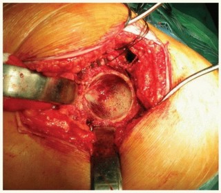 Illustration 3 for Cemented Acetabular Component: Achieving Optimal THA Stability
