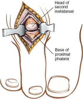 Illustration 220 for Optimized Approaches to the Dorsum of the Foot & Ankle
