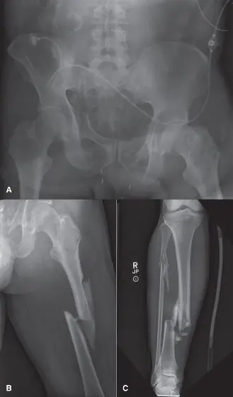جراحة التحكم بالضرر في العظام: نهج إنقاذ الحياة لاستعادة التعافي من الإصابات المعقدة