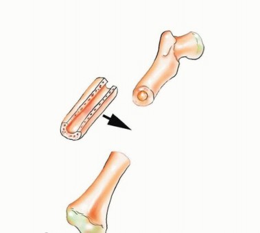 Illustration 33 for Free Vascularized Fibular Grafts: Solving Complex Bone Defects