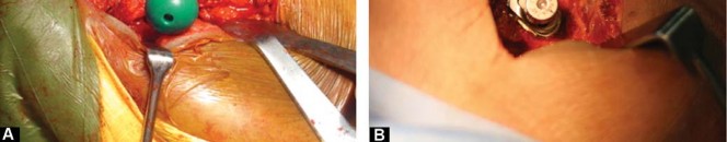 Illustration 21 for Considering METHA Short Stem? Discover Bone-Preserving THA