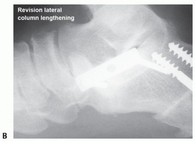 Illustration 31 for Lateral Column Lengthening: Relieve Flatfoot Pain & Correct Deformity