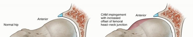 Illustration 5 for Hip Arthroscopy: Your Minimally Invasive Solution for Hip Pain
