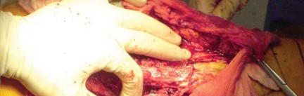 Illustration 20 for Effective Arthroplasty for Salvage of Failed Hip Fixation