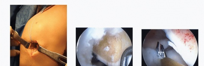 Illustration 23 for Symptomatic Knee? Meniscal Transplant for Anterior & Posterior Horns
