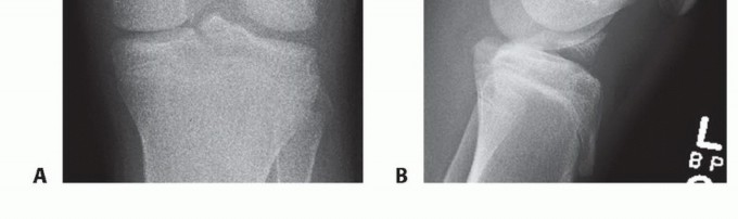 Illustration 8 for Treating Tibial Spine Fractures: Arthroscopy or Open Reduction?