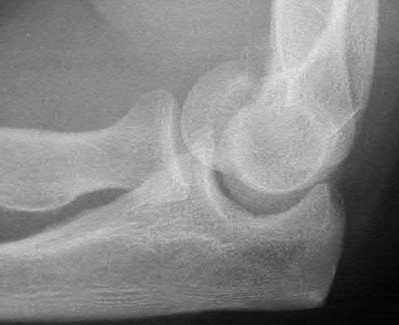 Illustration 75 for OrthoCash: Trauma MCQs & Cases for a yearold woman