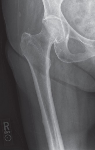 Illustration of subtrochanteric femur fractures - Dr. Mohammed Hutaif