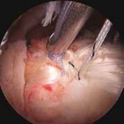 Illustration 13 for Resolve Long Head Biceps Pain: Advanced Arthroscopic Treatment