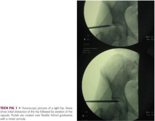 Illustration 76 for Precision Hip Arthroscopy: Unlock Access to the Peripheral Compartment