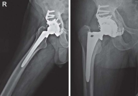Illustration 55 for Optimizing Arthroplasty in Acute Fractures: Octopus System