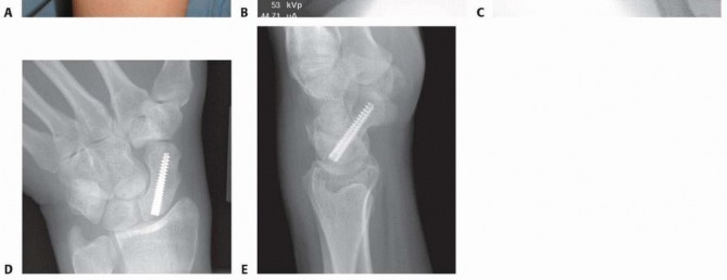 Illustration 4 for Mastering Percutaneous Fixation of Acute Scaphoid Fractures