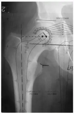 صورة توضيحية لـ السيقان المصقولة المخروطية المثبتة بالإسمنت: حل متفوق لاستبدال مفصل الورك
