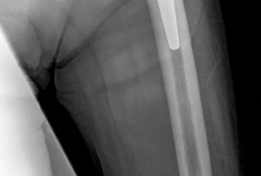 Illustration 6 for Acetabular Revision: Solving Challenges Post Two-Stage Arthroplasty