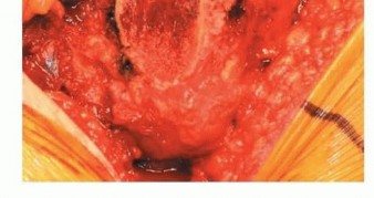 صورة طبية: استبدال مفصل الورك بدون أسمنت: استعادة الحركة والثبات في صنعاء مع الأستاذ الدكتور محمد هطيف