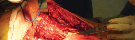 Illustration 14 for Effective Arthroplasty for Salvage of Failed Hip Fixation