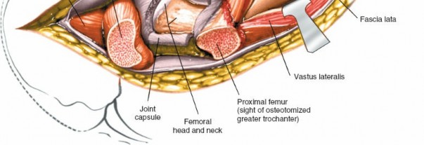 Illustration 128 for Unlocking Every Aspect of the Hip's Surgical Approaches