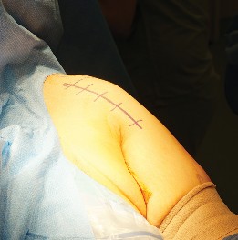 Unlocking the Best Surgical Approaches to the Shoulder