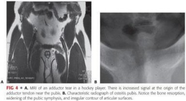 Illustration 54 for Solving Chronic Groin Pain in Athletes: Pubalgia Explained