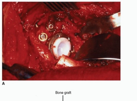 Illustration 11 for Recreate Hip Biomechanics: Modular Stems for Modular Solutions