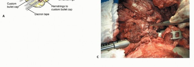 Illustration 27 for Mastering Hip Disarticulation: Through the Hip Joint Capsule