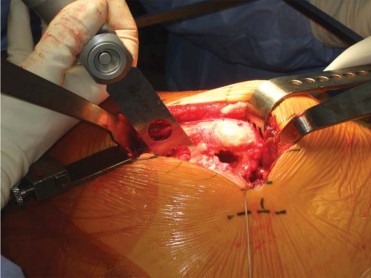 Illustration 79 for Successful Total Hip Replacement in Developmental Dysplasia